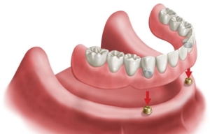 Drawing of an implant retained lower denture, showing locator-type implant posts in the gum that the removable denture snaps onto