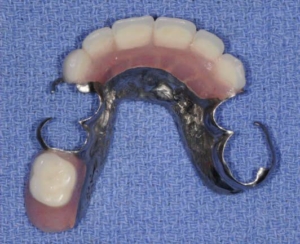 A Partial Upper Cast Denture with front anterior teeth and one back molar tooth